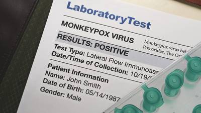 Monkeypox: Roche, Abbott developing tests for virus